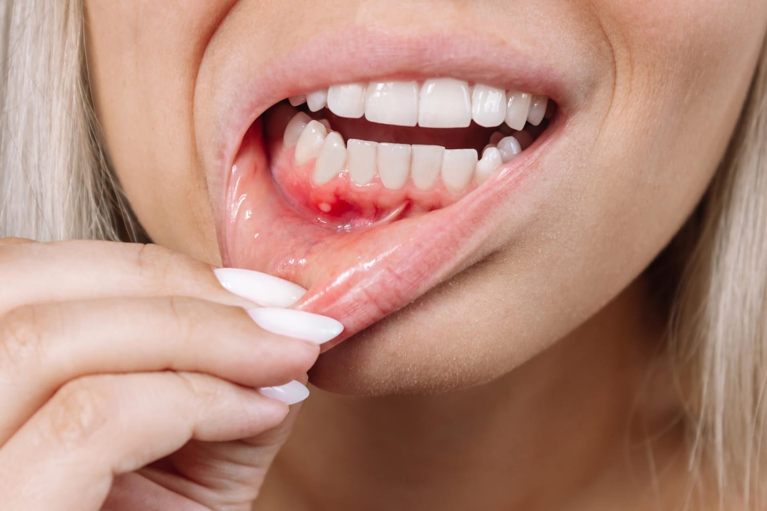 A woman pulls down her lower lip to reveal a painful canker sore inside her mouth.