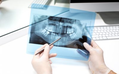 Dental X-Rays Explained: Are They Safe and Why Are They Important?