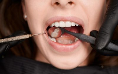 Dental Sealants for Kids: How They Help Prevent Cavities